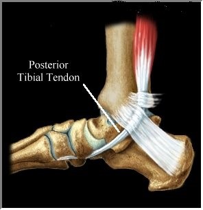 Posterior deals tibial tendonitis